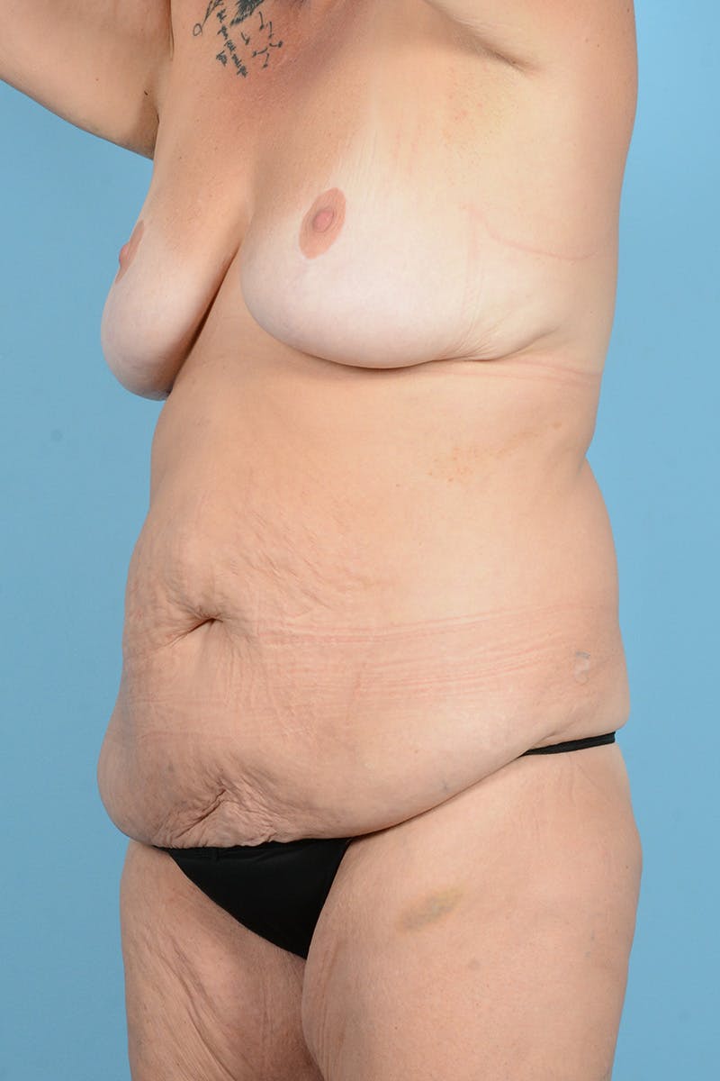 Tummy Tuck Before & After Gallery - Patient 887018 - Image 7