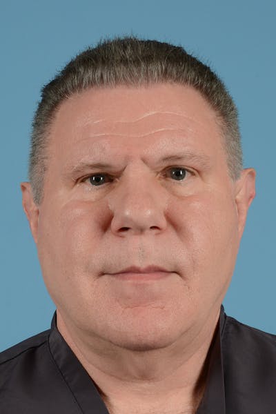 Facelift Before & After Gallery - Patient 262698 - Image 1