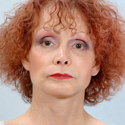 Facial Augmentation Before & After Gallery - Patient 956867 - Image 2