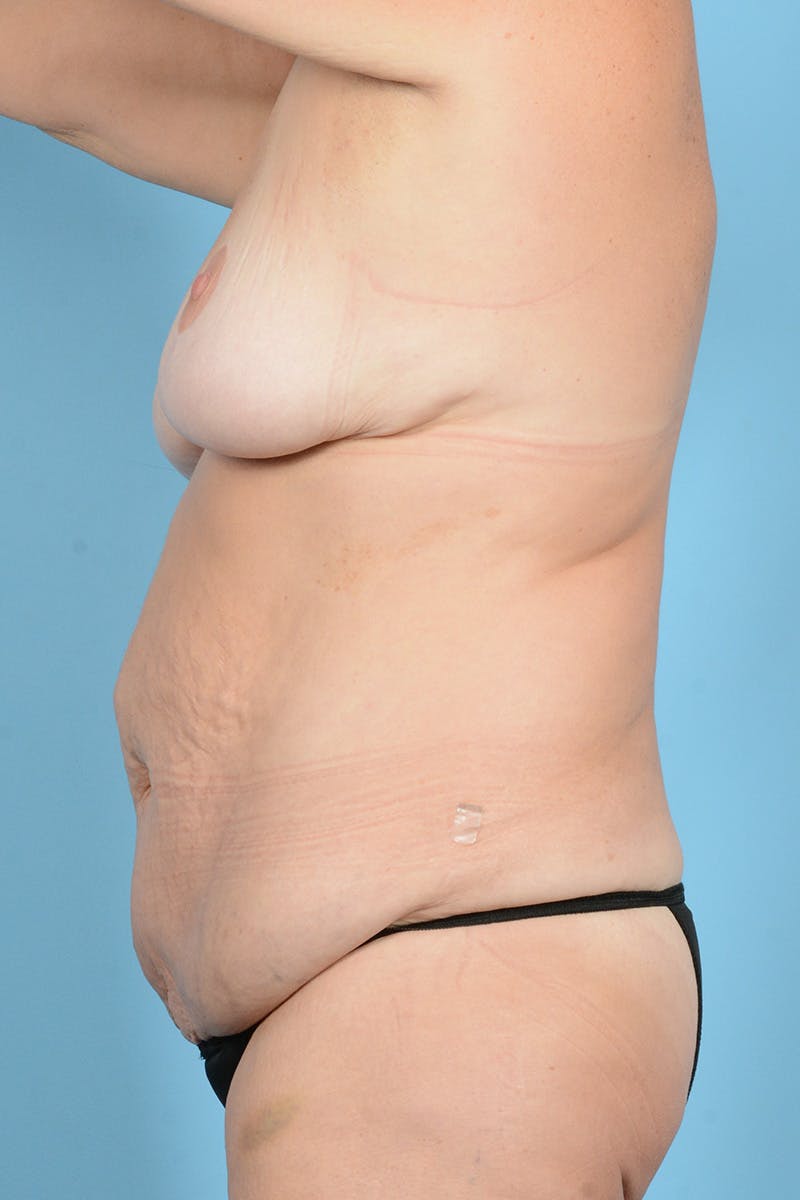 Tummy Tuck Before & After Gallery - Patient 887018 - Image 9