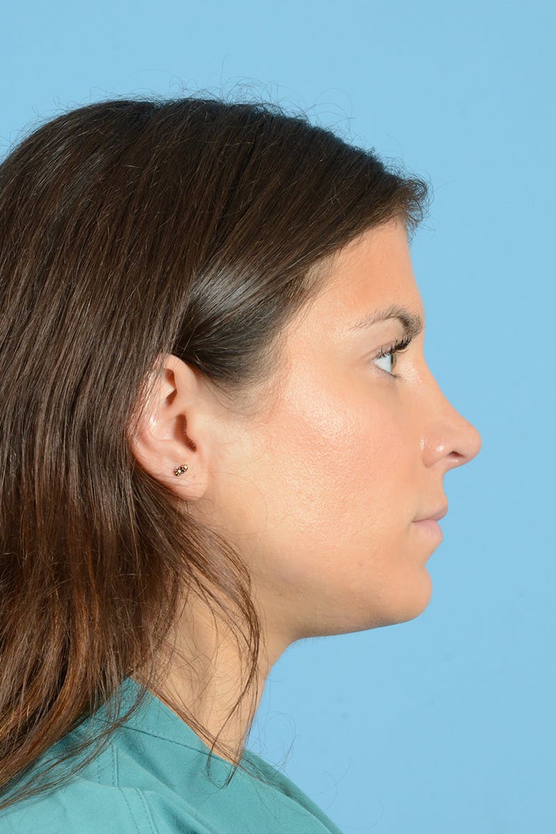 Rhinoplasty Before & After Gallery - Patient 380529 - Image 6