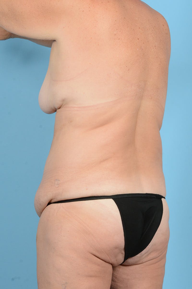 Tummy Tuck Before & After Gallery - Patient 887018 - Image 11