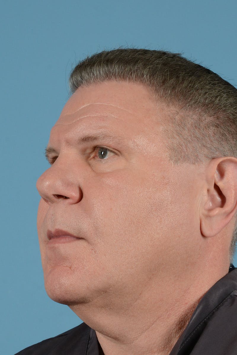 Facelift Before & After Gallery - Patient 262698 - Image 7