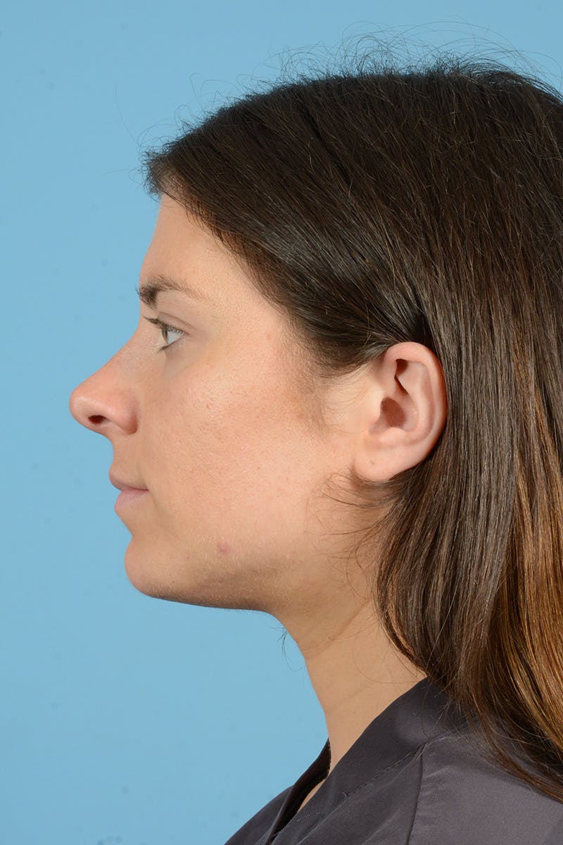 Rhinoplasty Before & After Gallery - Patient 380529 - Image 9