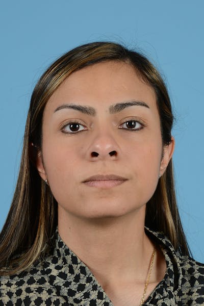 Rhinoplasty Before & After Gallery - Patient 250987 - Image 1