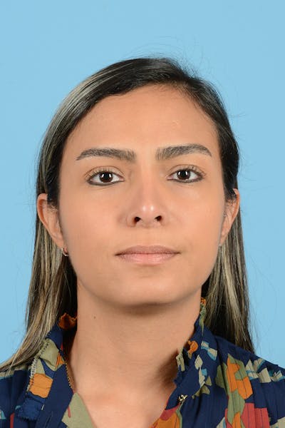 Rhinoplasty Before & After Gallery - Patient 250987 - Image 2