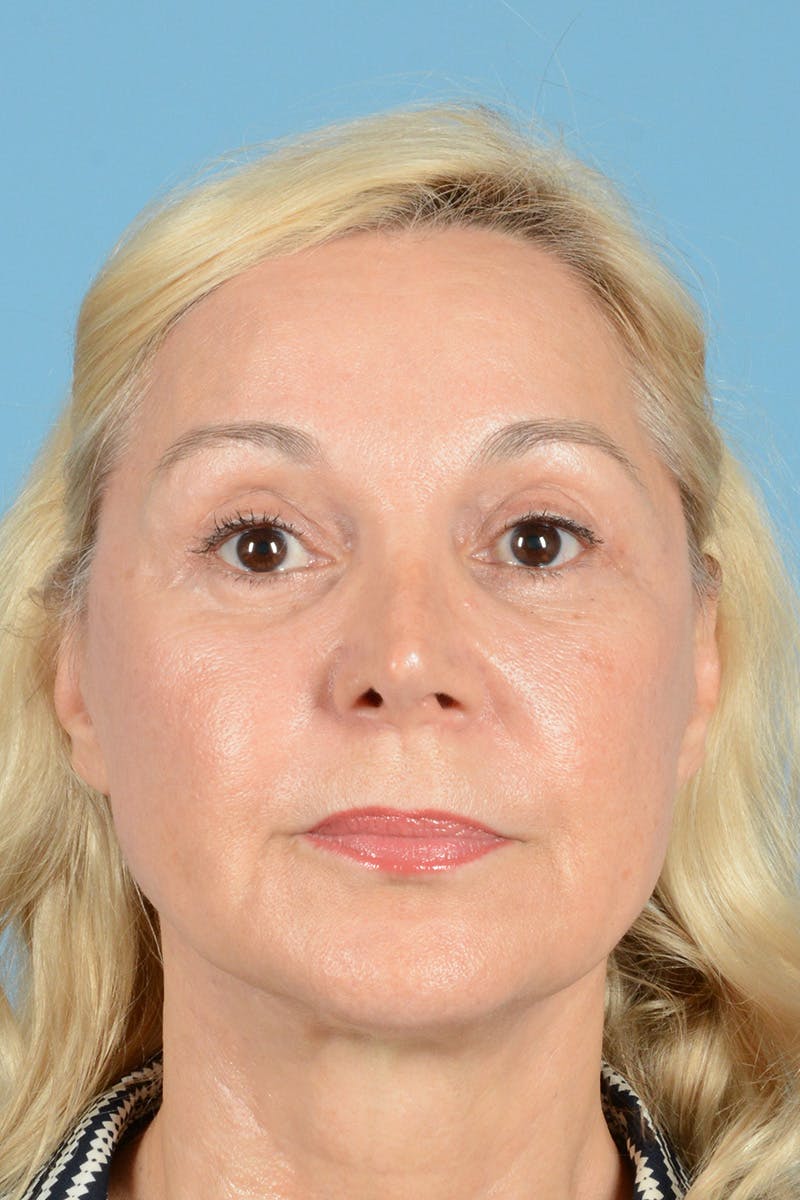 Facelift Before & After Gallery - Patient 139827 - Image 2