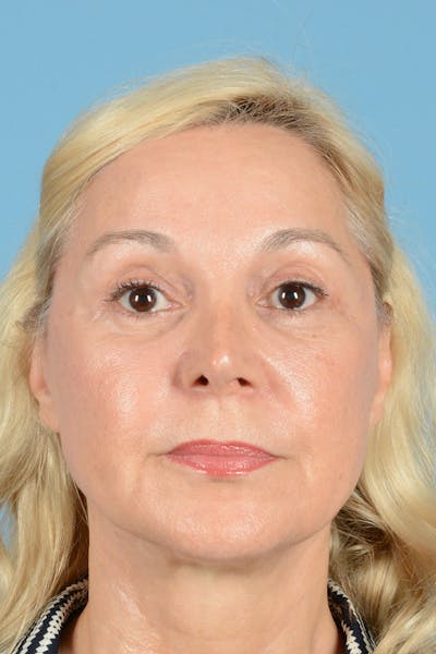Facelift Before & After Gallery - Patient 139827 - Image 2