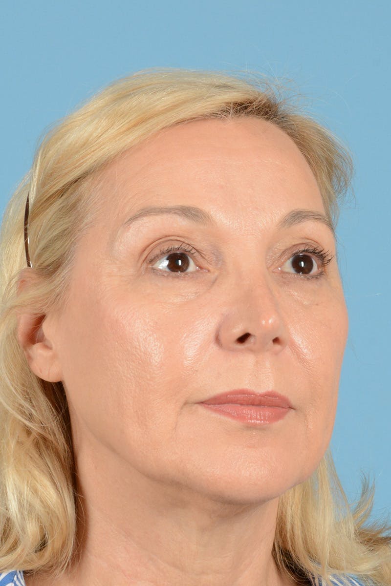Facelift Before & After Gallery - Patient 139827 - Image 3