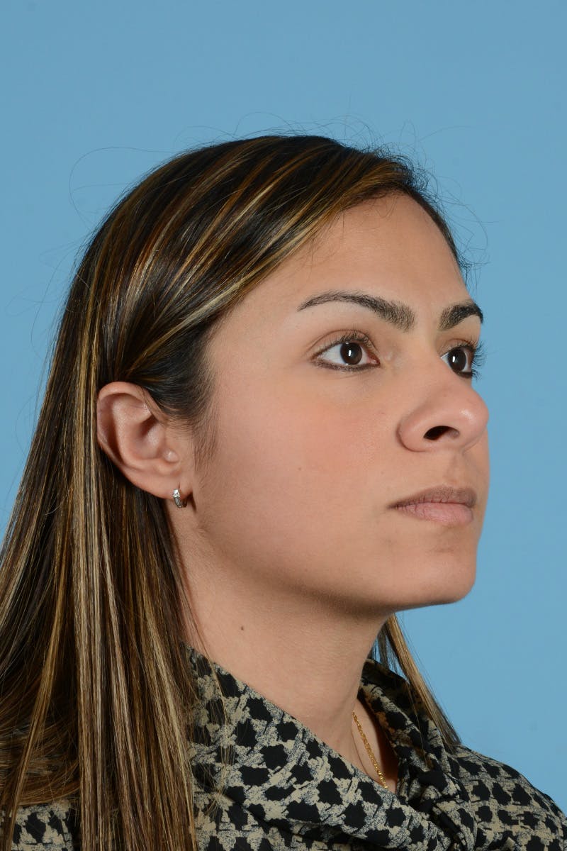 Rhinoplasty Before & After Gallery - Patient 250987 - Image 3
