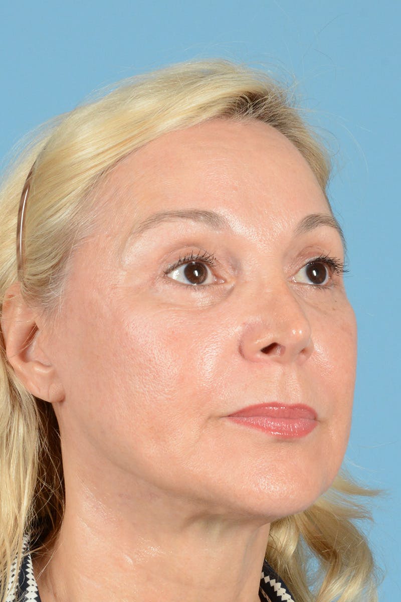 Facelift Before & After Gallery - Patient 139827 - Image 4