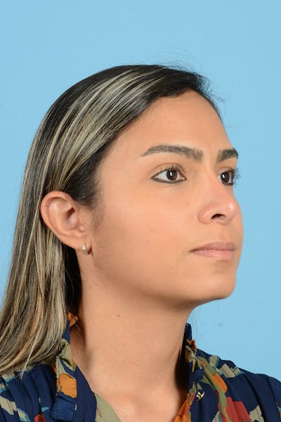 Rhinoplasty Before & After Gallery - Patient 250987 - Image 4