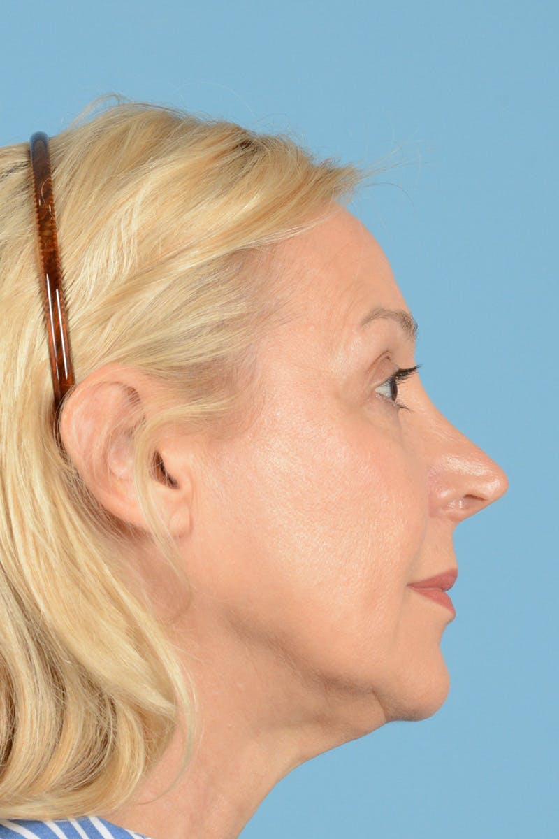Facelift Before & After Gallery - Patient 139827 - Image 5
