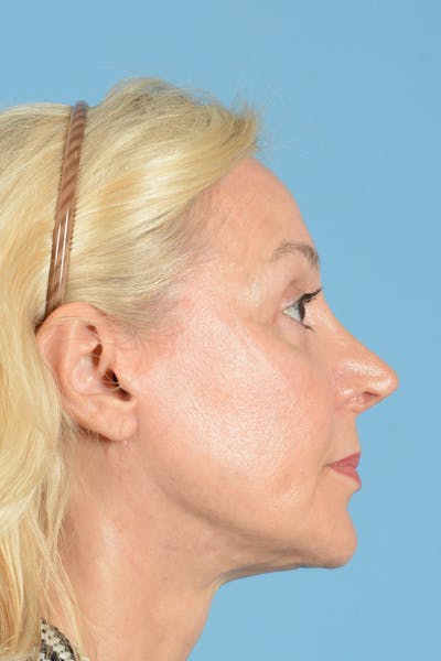 Facelift Before & After Gallery - Patient 139827 - Image 6