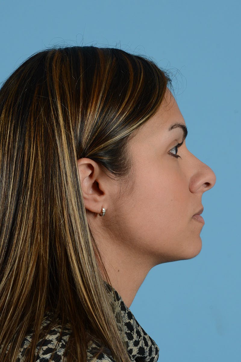 Rhinoplasty Before & After Gallery - Patient 250987 - Image 5