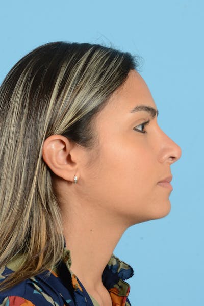 Rhinoplasty Before & After Gallery - Patient 250987 - Image 6