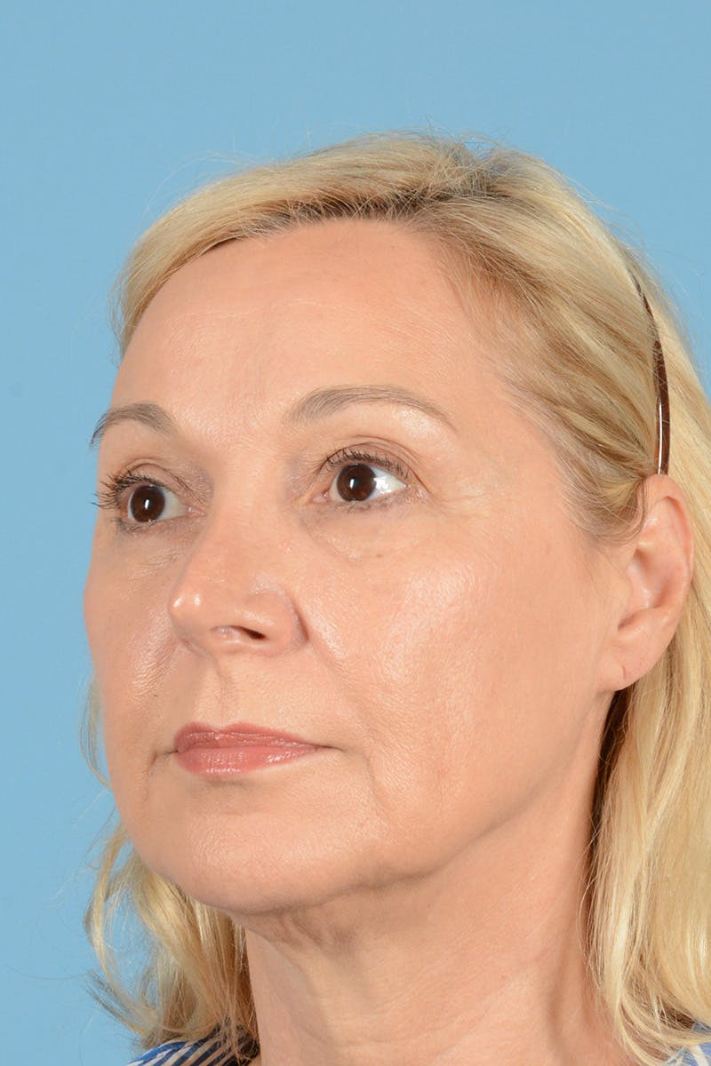 Facelift Before & After Gallery - Patient 139827 - Image 7