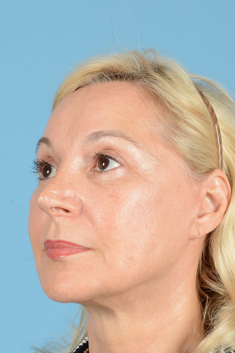 Facelift Before & After Gallery - Patient 139827 - Image 8