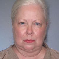 Eyelid Lift Before & After Gallery - Patient 319402 - Image 1
