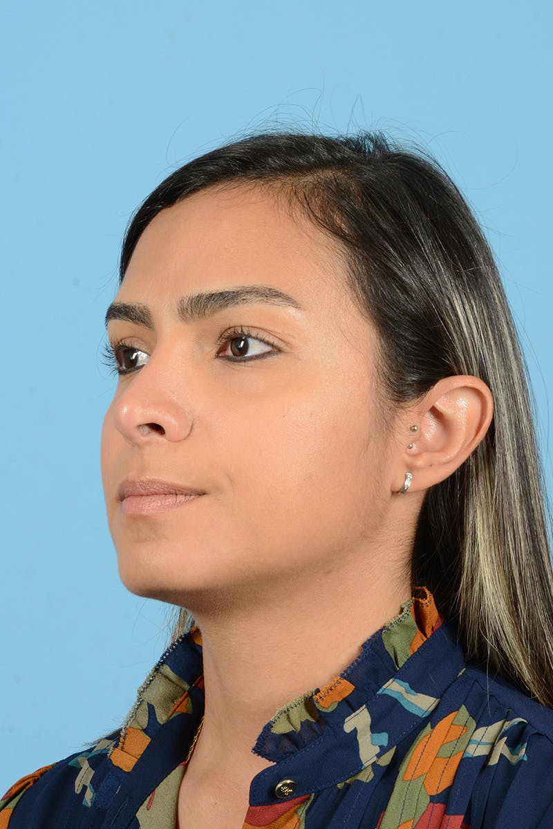 Rhinoplasty Before & After Gallery - Patient 250987 - Image 8