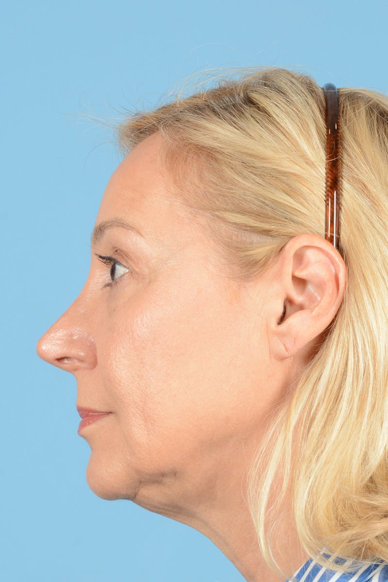 Facelift Before & After Gallery - Patient 139827 - Image 9