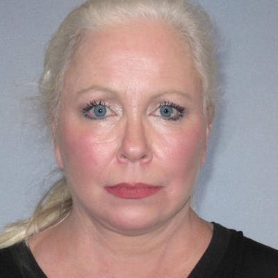 Eyelid Lift Before & After Gallery - Patient 319402 - Image 2