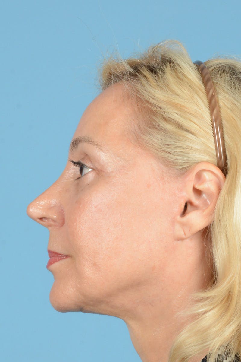 Facelift Before & After Gallery - Patient 139827 - Image 10