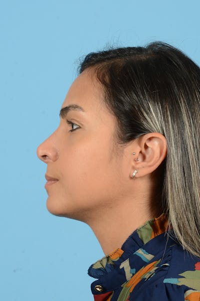 Rhinoplasty Before & After Gallery - Patient 250987 - Image 10