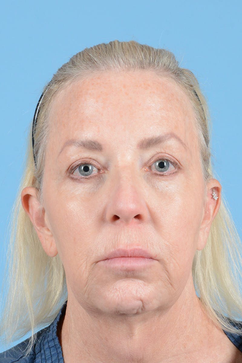 Facelift Before & After Gallery - Patient 301007 - Image 1