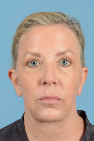 Facelift Before & After Gallery - Patient 301007 - Image 2