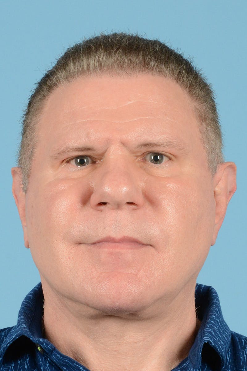 Neck Lift Before & After Gallery - Patient 188228 - Image 2