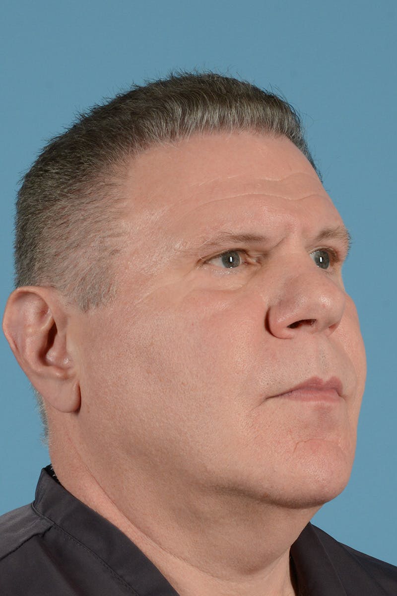 Neck Lift Before & After Gallery - Patient 188228 - Image 3