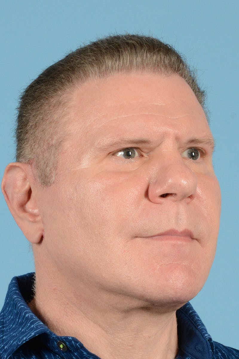 Neck Lift Before & After Gallery - Patient 188228 - Image 4