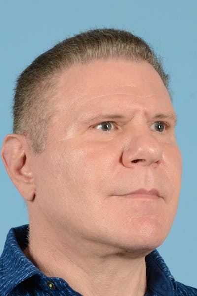 Neck Lift Before & After Gallery - Patient 188228 - Image 4