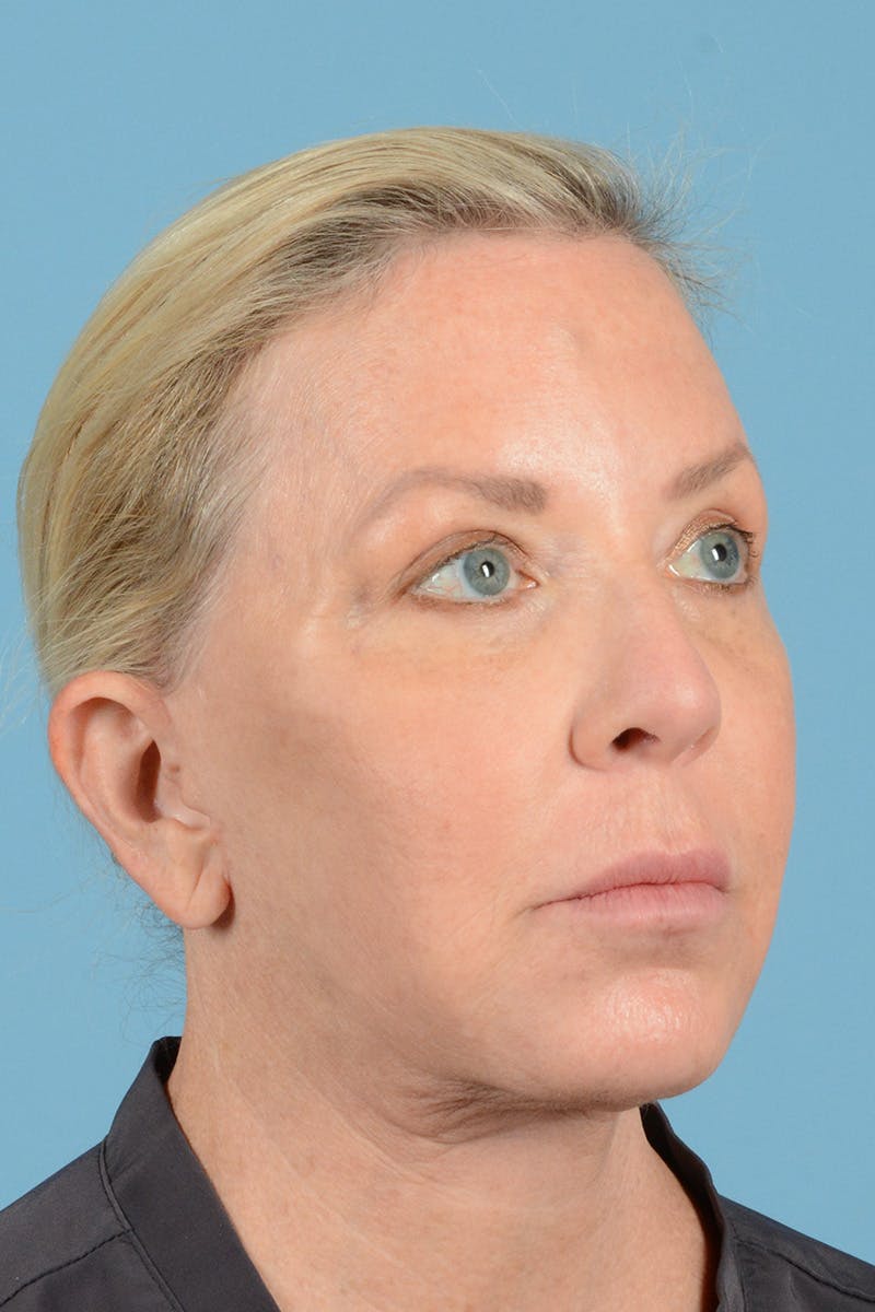 Facelift Before & After Gallery - Patient 301007 - Image 4