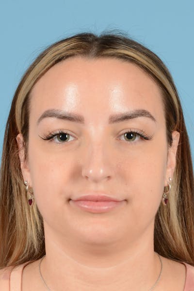 Liposuction Before & After Gallery - Patient 411155 - Image 1