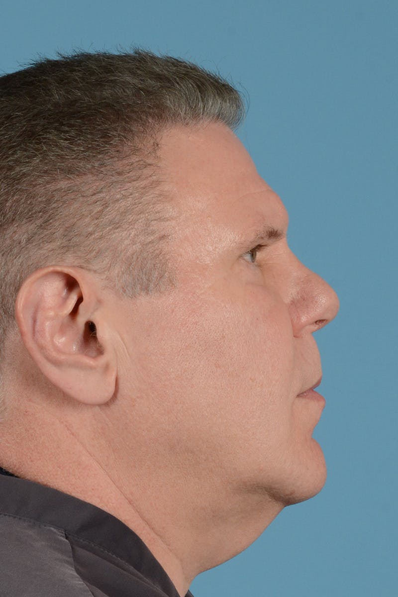 Neck Lift Before & After Gallery - Patient 188228 - Image 5