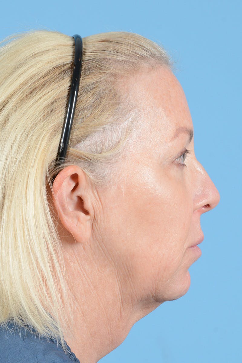 Facelift Before & After Gallery - Patient 301007 - Image 5
