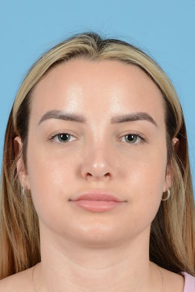 Liposuction Before & After Gallery - Patient 411155 - Image 2