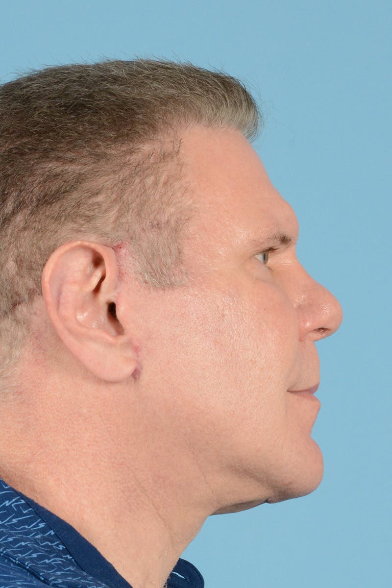 Neck Lift Before & After Gallery - Patient 188228 - Image 6