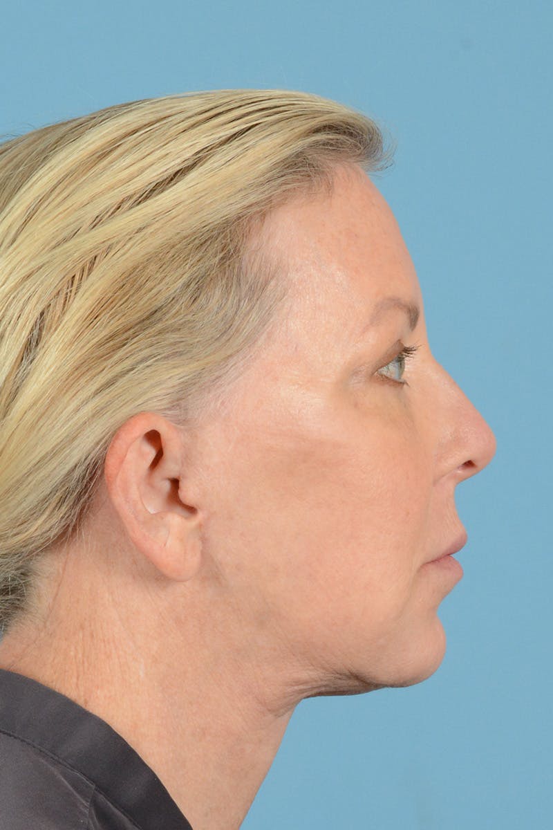 Facelift Before & After Gallery - Patient 301007 - Image 6