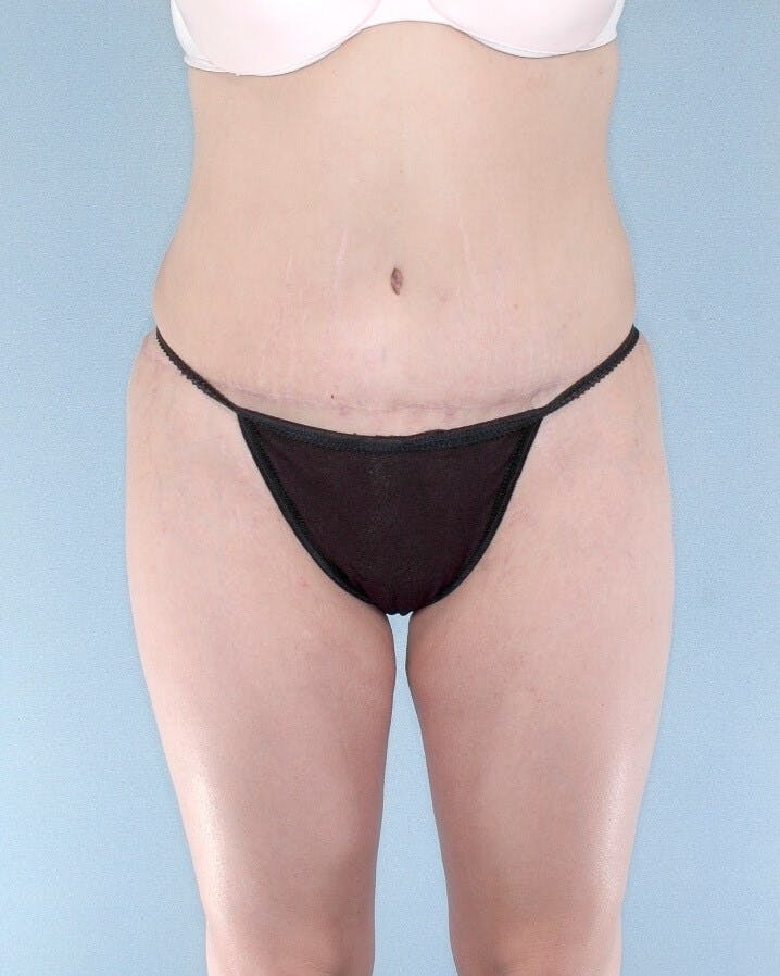 Tummy Tuck Before & After Gallery - Patient 185235 - Image 2