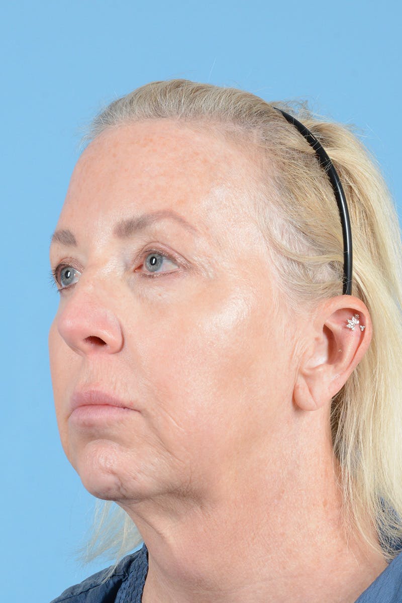 Facelift Before & After Gallery - Patient 301007 - Image 7