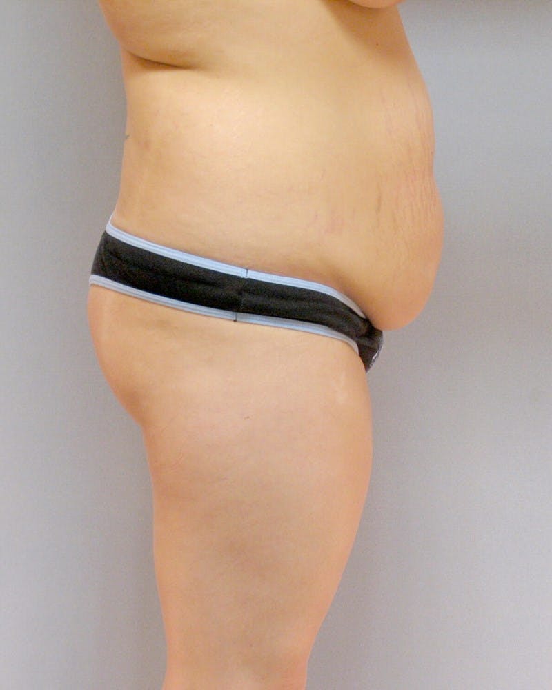 Tummy Tuck Before & After Gallery - Patient 185235 - Image 3