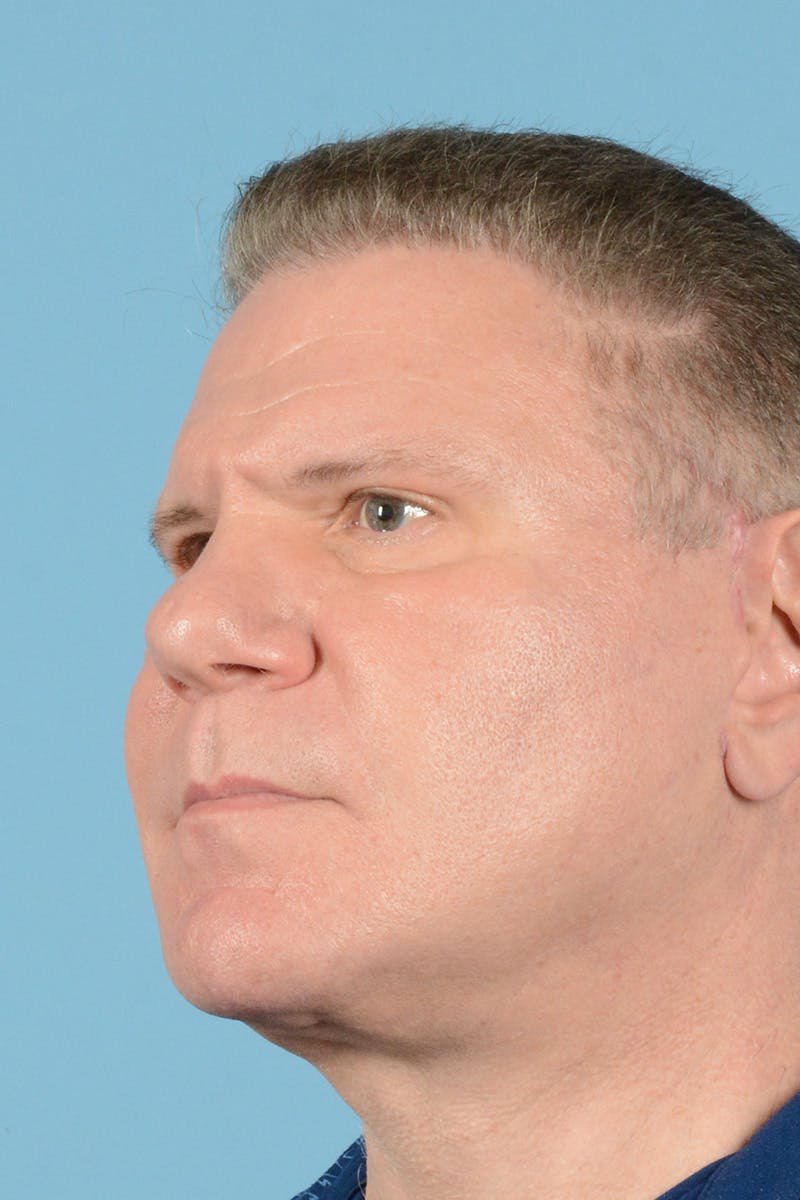 Neck Lift Before & After Gallery - Patient 188228 - Image 8