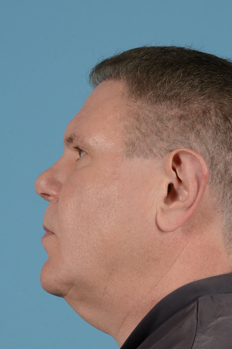 Neck Lift Before & After Gallery - Patient 188228 - Image 9
