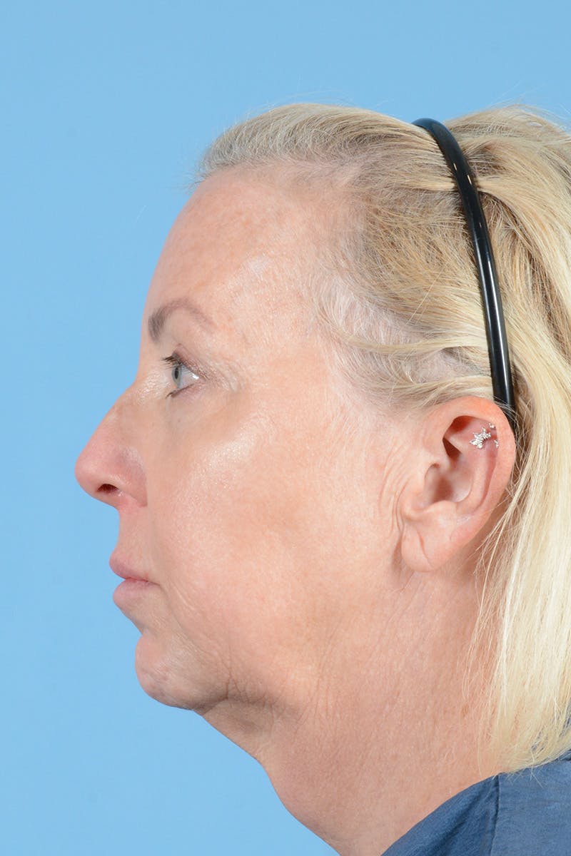 Facelift Before & After Gallery - Patient 301007 - Image 9