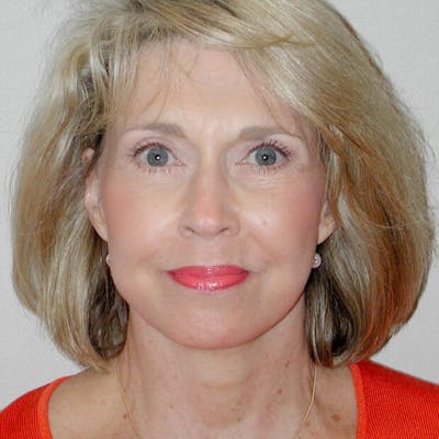 Eyelid Lift Before & After Gallery - Patient 159413 - Image 2
