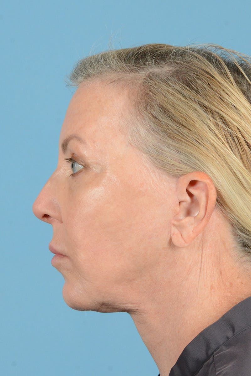 Facelift Before & After Gallery - Patient 301007 - Image 10