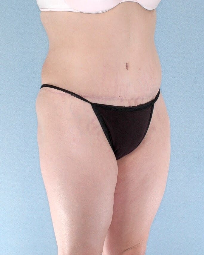 Tummy Tuck Before & After Gallery - Patient 185235 - Image 8